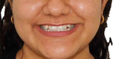 antes
