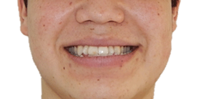 antes